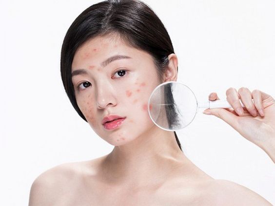 Skincare cho da dầu mụn tuổi dậy thì: Bí quyết chiến thắng mụn