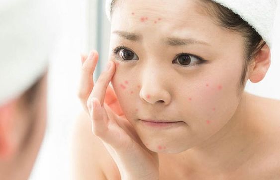 Skincare tối giản cho da mụn: 4 bước đơn giản cho làn da khỏe đẹp